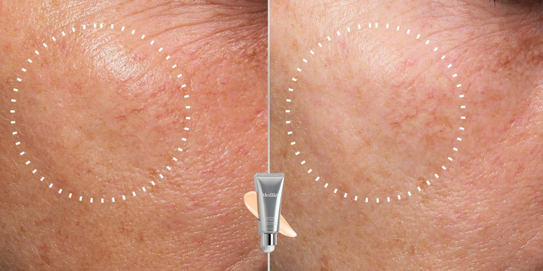 retinal en de gevoelige huid Skincare Boulevard